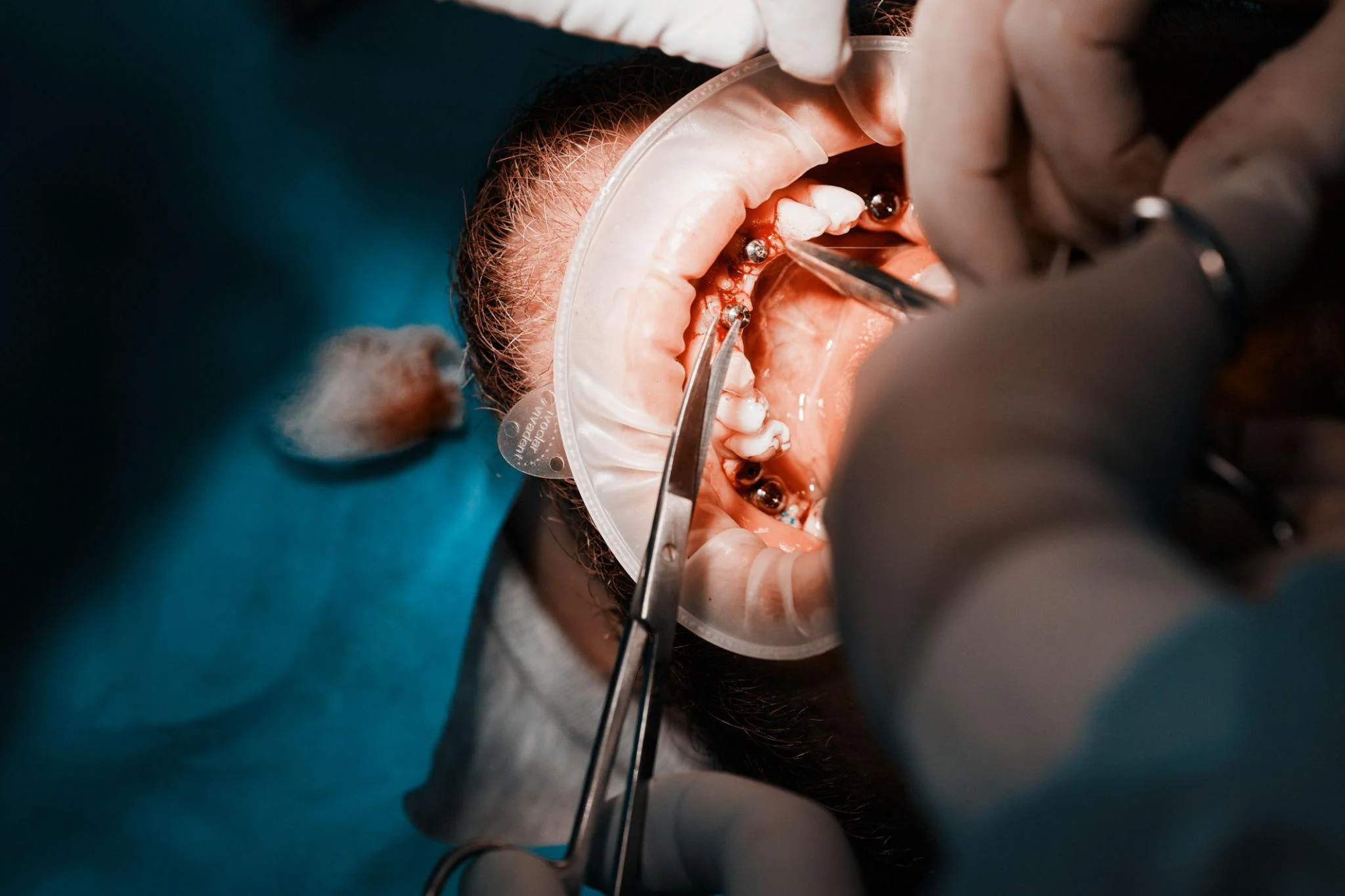 Dental Implant
