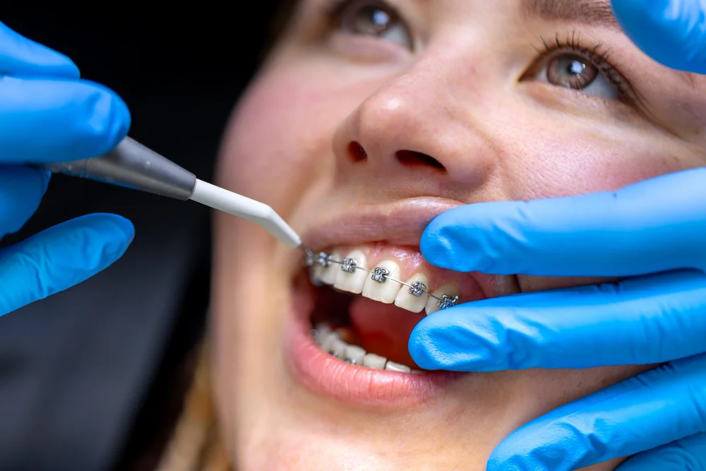Orthodontic Treatment
