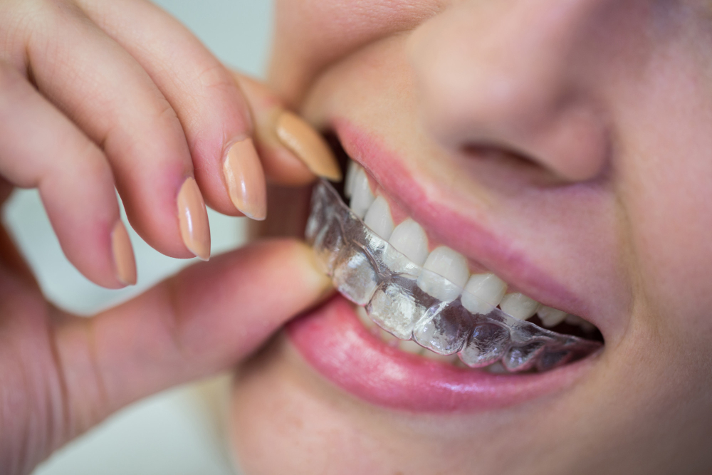 Braces & Clear Aligners